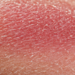 Follicules pileux cellules sentinelles microbes featured