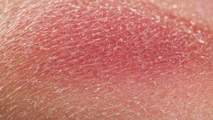 Follicules pileux cellules sentinelles microbes featured