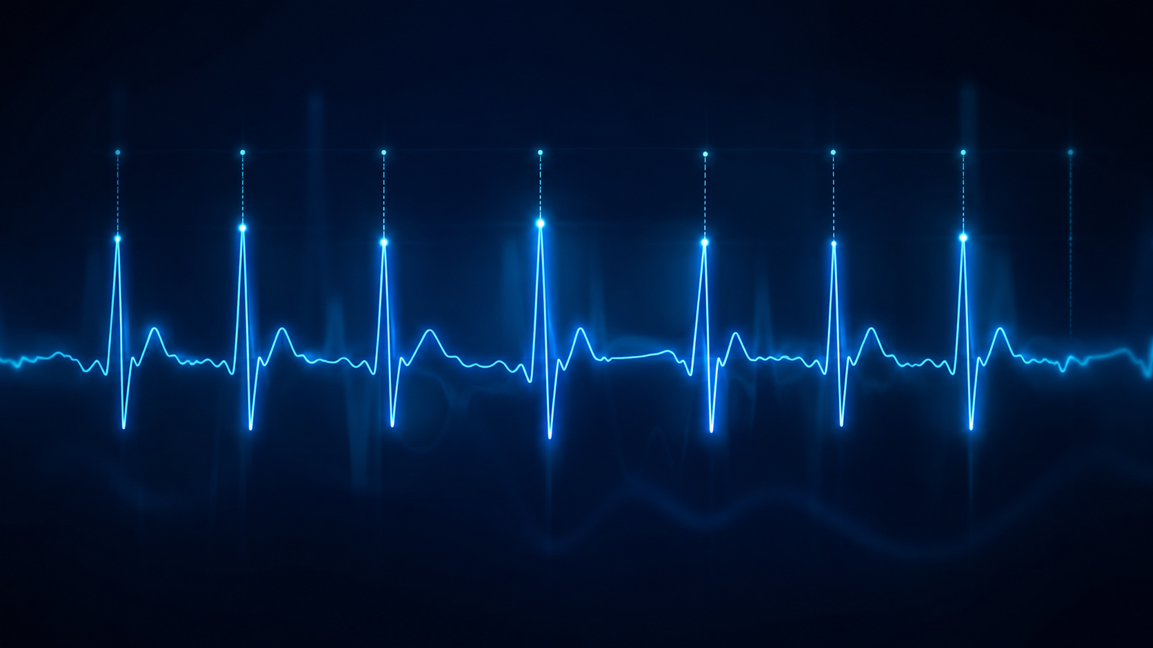 Representation graphique d’un rythme cardiaque montrant la variabilite des intervalles entre les battements