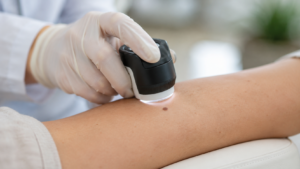 Main gantée posant un petit appareil optique de poche sur un grain de beauté au bras d'un patient