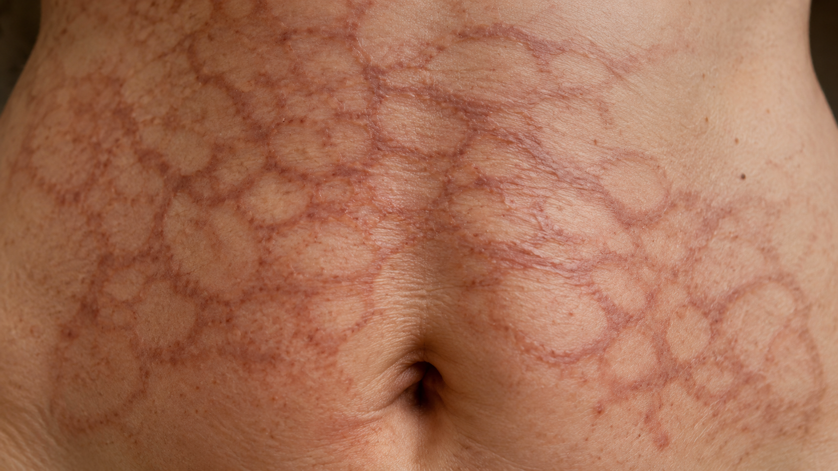 Gros plan sur une peau d’abdomen marquée d’un réseau brun-rouge aux lignes entrelacées.